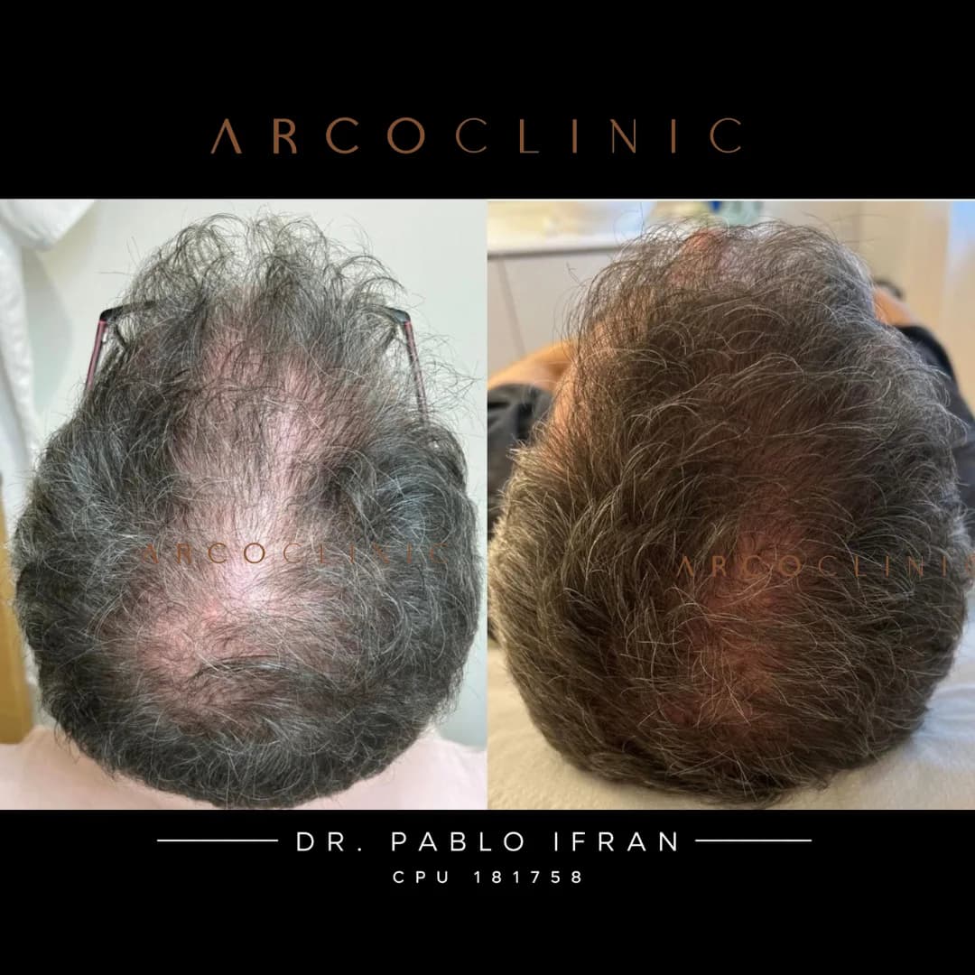 Registro clínico de la parte superior de la cabeza, antes a la izquierda y después a la derecha, de paciente con alopecia androgenética tratado por el Dr. Pablo Ifrán en Uruguay