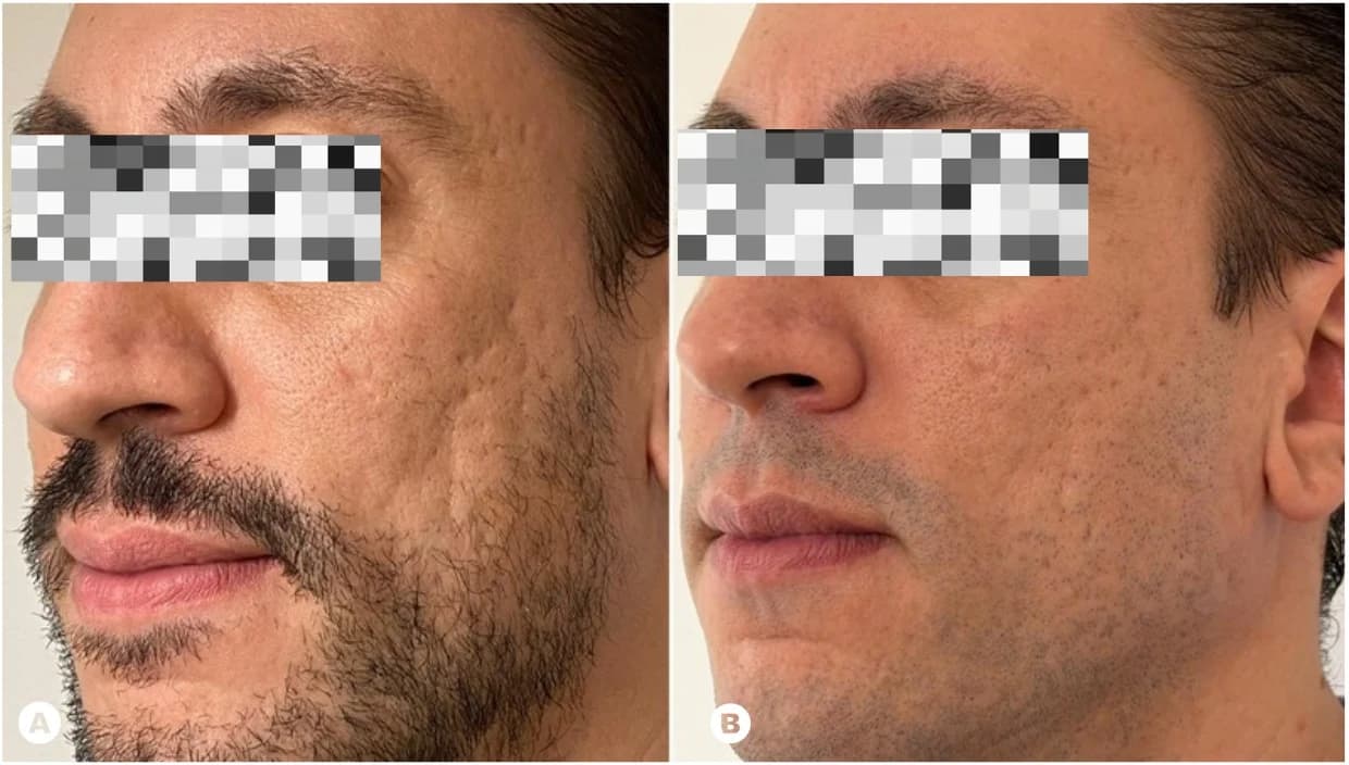 Antes (A) y después (B): mejilla con cicatrices atróficas de acné y la misma región con textura visiblemente remodelada