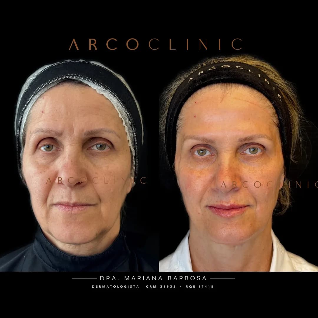 Registro clínico de frente, antes à esquerda e depois à direita, de paciente tratada com o Lift ARCO