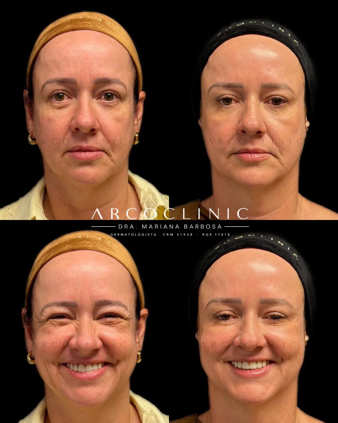 Registro clínico de frente, antes à esquerda e depois à direita, em repouso e sorrindo, após Botox em face completa e pescoço com laser de CO₂ full face