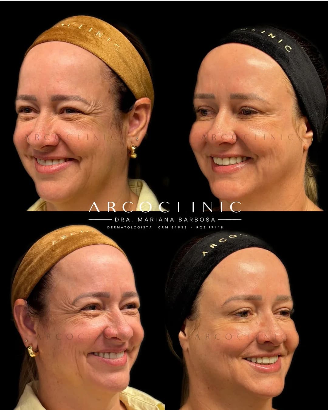 Registro clínico em três quartos, antes à esquerda e depois à direita, sorrindo, após Botox em face completa e pescoço com laser de CO₂ full face
