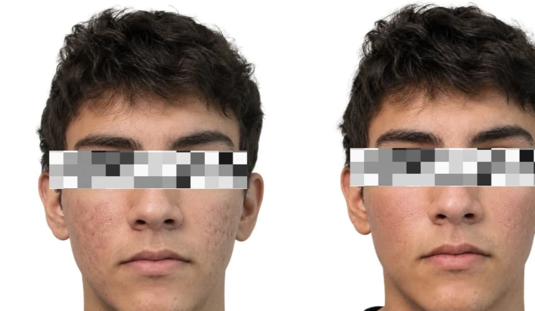 Antes y después de un paciente joven: piel con acné y marcas a la izquierda, piel visiblemente más uniforme a la derecha